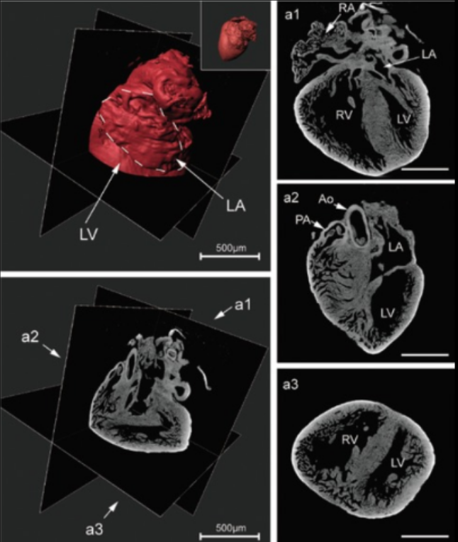 Cardiomyopathy
